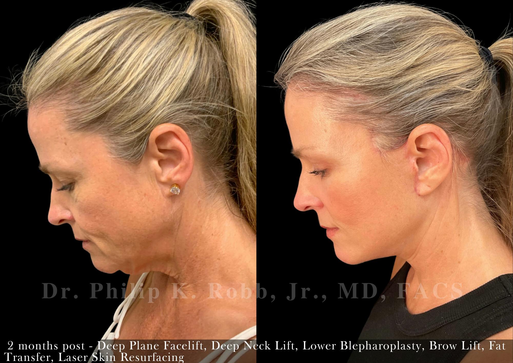 Brow Lift Before & After Gallery - Patient 158459 - Image 4