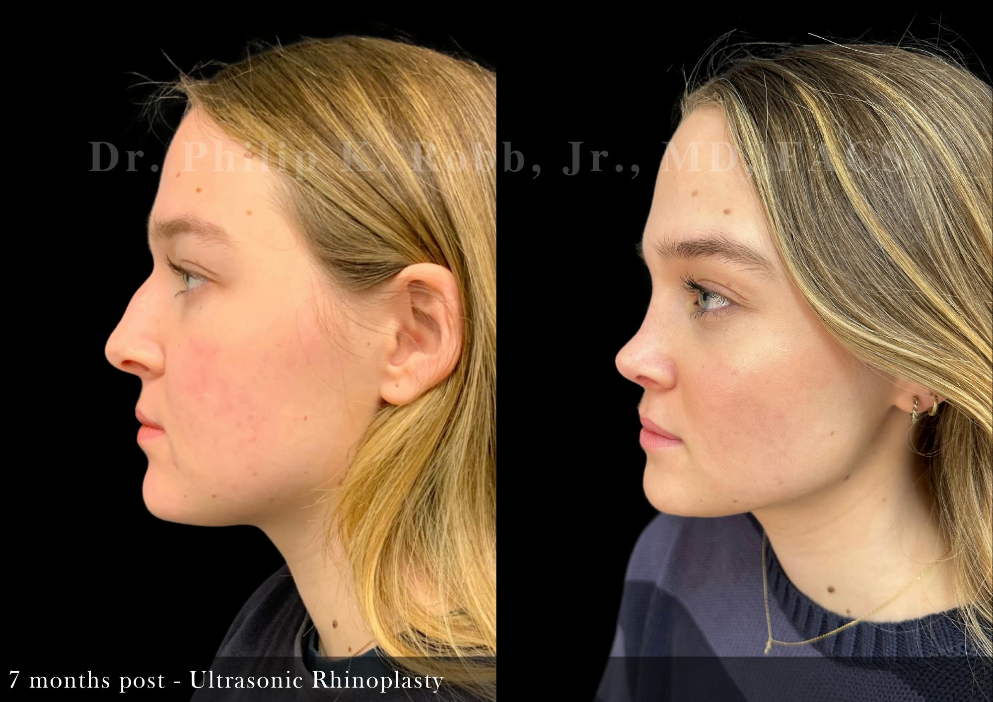 Ultrasonic Rhinoplasty Before & After Gallery - Patient 279060 - Image 4