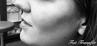 Facial Implants & Fat Transfer Before & After Gallery - Patient 235681 - Image 2