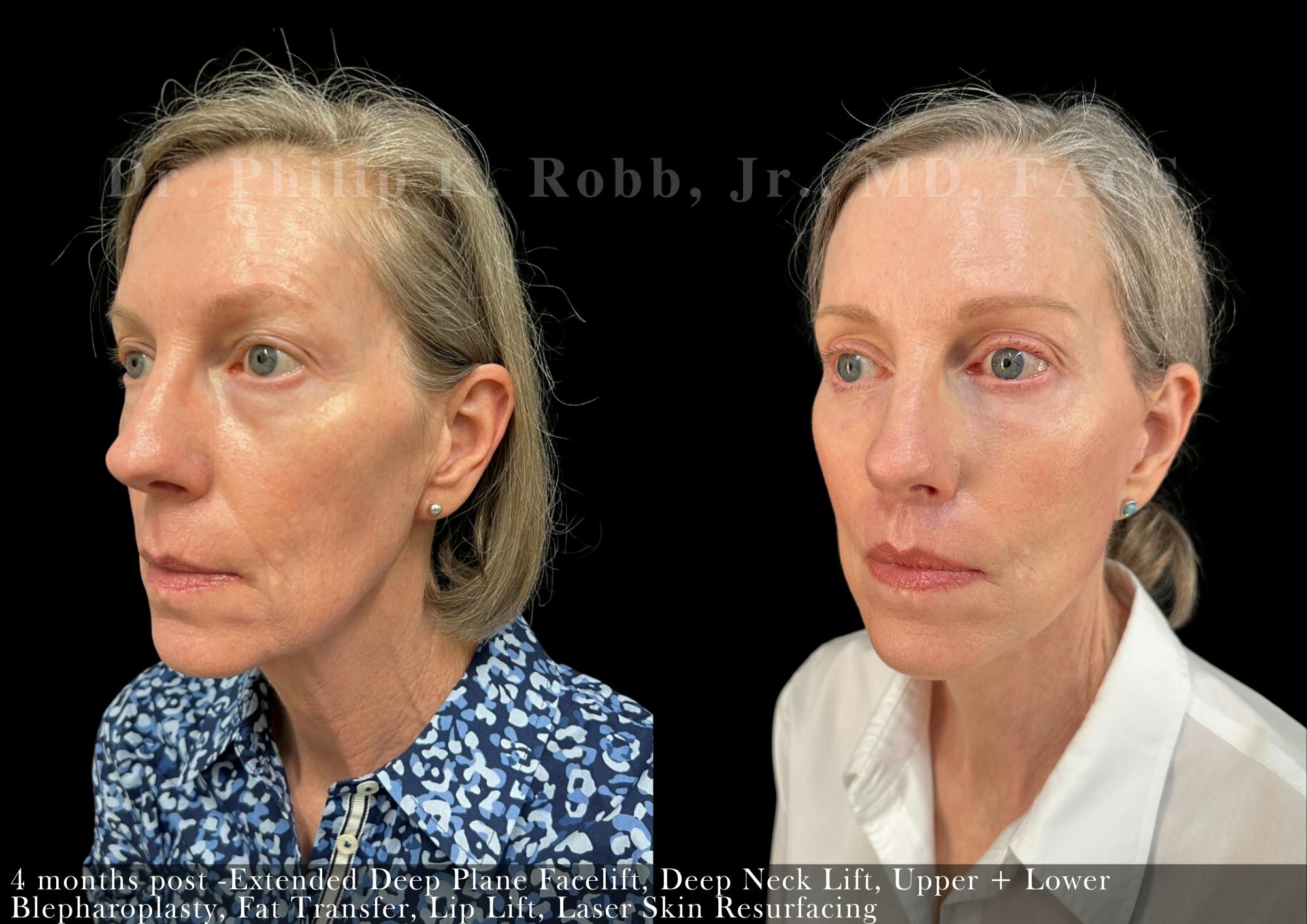 Facelift Before & After Gallery - Patient 332345 - Image 1