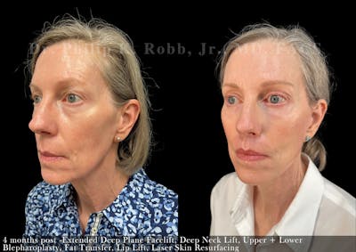 Facelift Before & After Gallery - Patient 332345 - Image 1