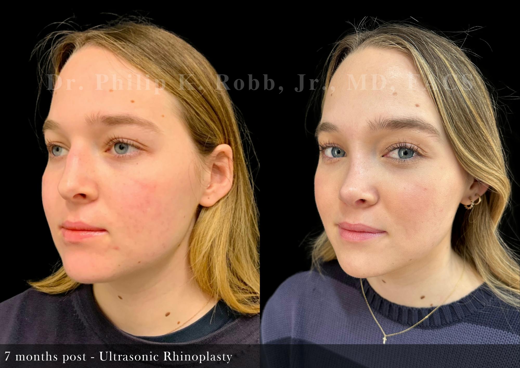 Ultrasonic Rhinoplasty Before & After Gallery - Patient 279060 - Image 5
