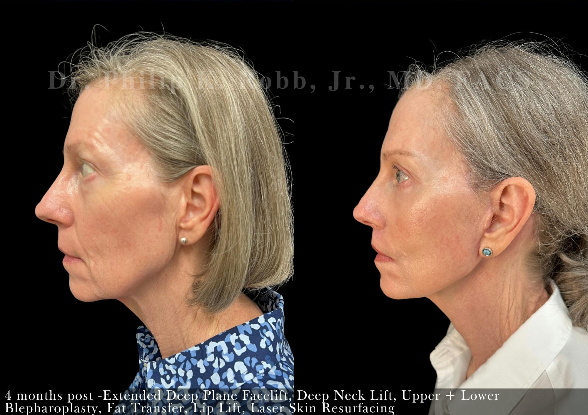 Facelift Before & After Gallery - Patient 332345 - Image 3
