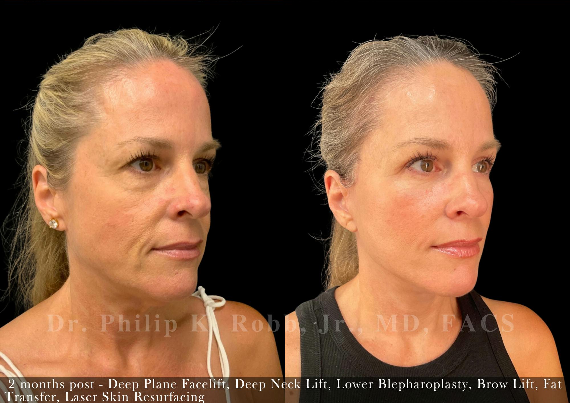Brow Lift Before & After Gallery - Patient 158459 - Image 5