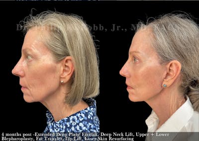 Neck Lift Before & After Gallery - Patient 234871 - Image 1
