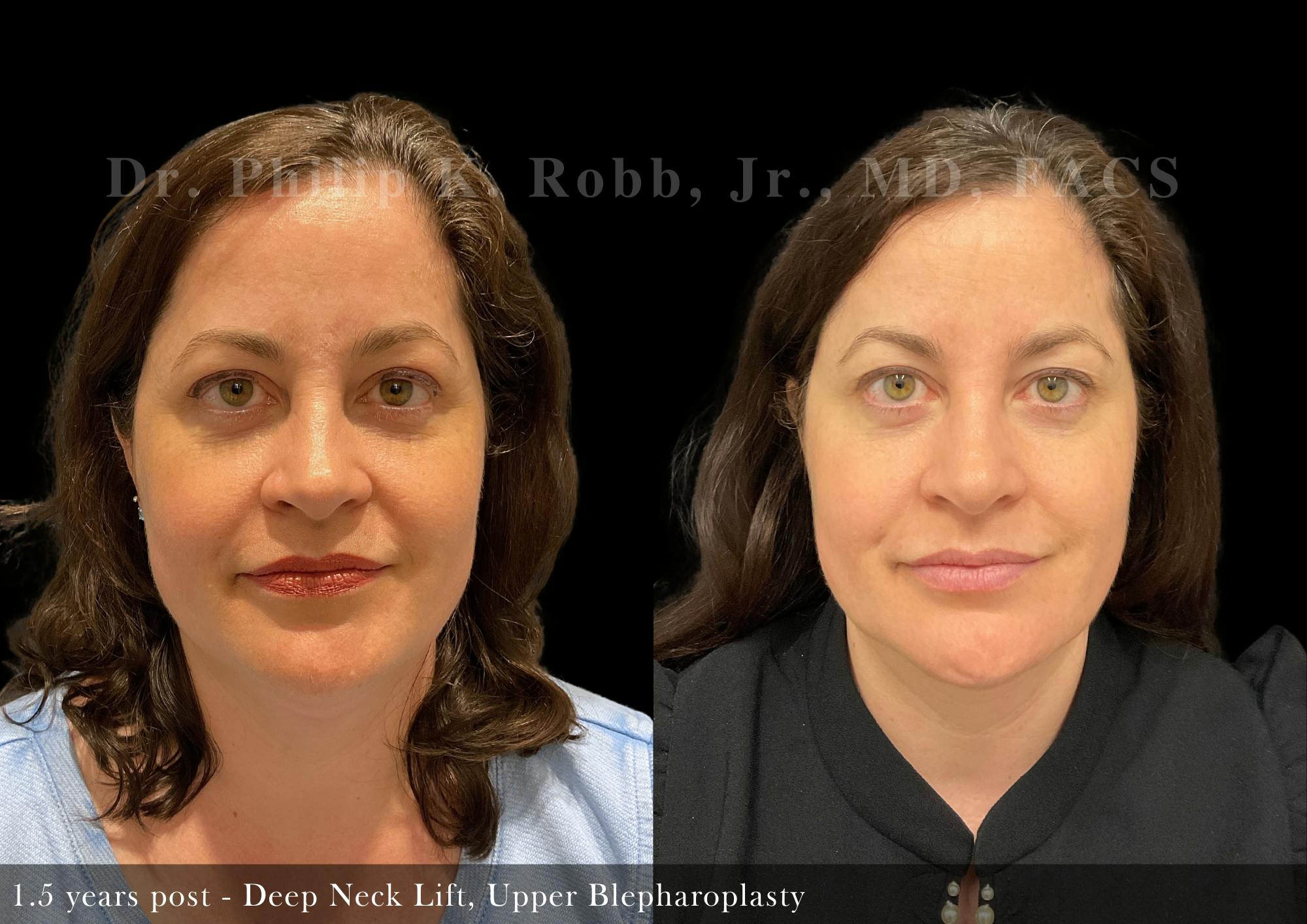 Neck Lift Before & After Gallery - Patient 220191 - Image 1