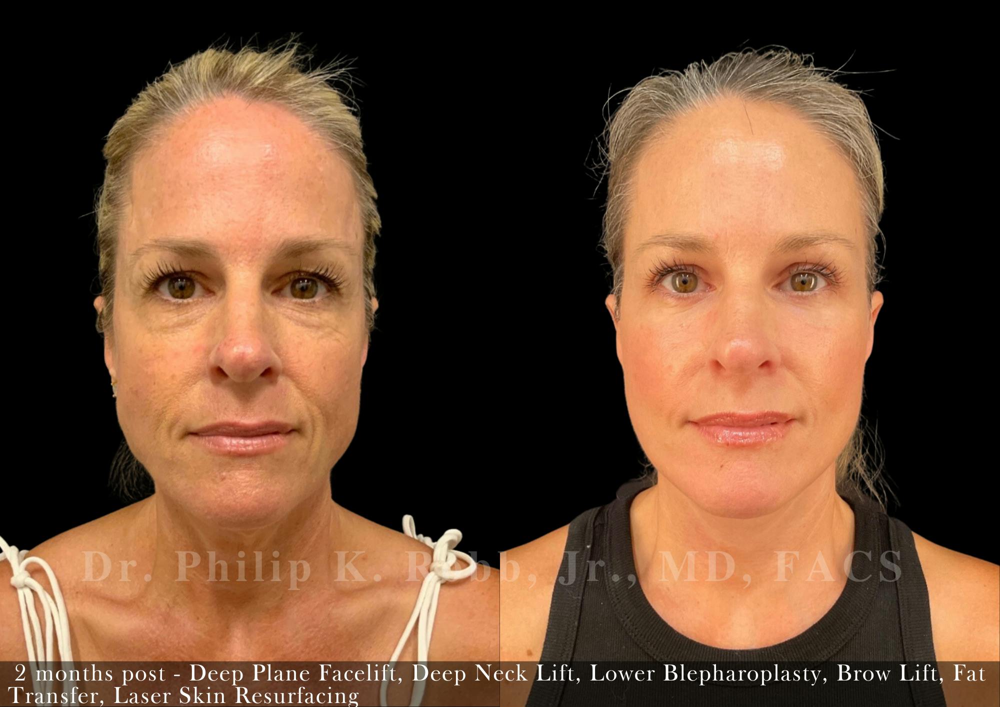 Facelift Before & After Gallery - Patient 416925 - Image 4