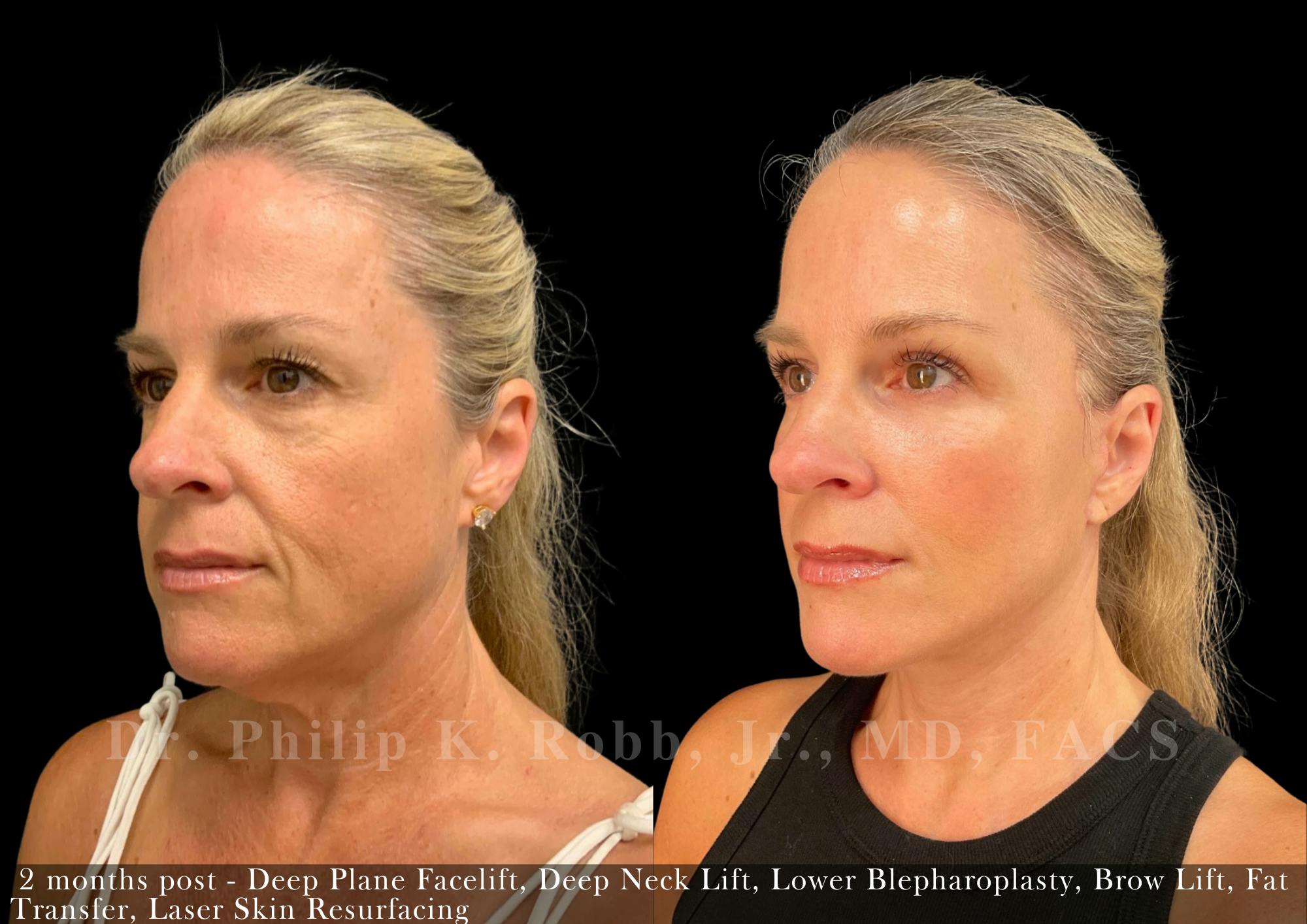 Facelift Before & After Gallery - Patient 416925 - Image 1