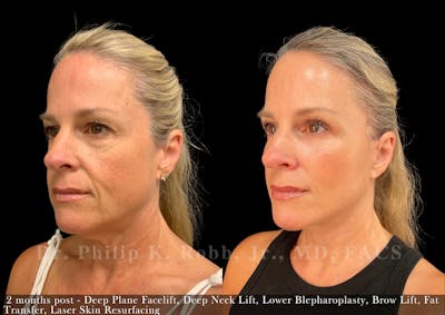 Facelift Before & After Gallery - Patient 416925 - Image 1