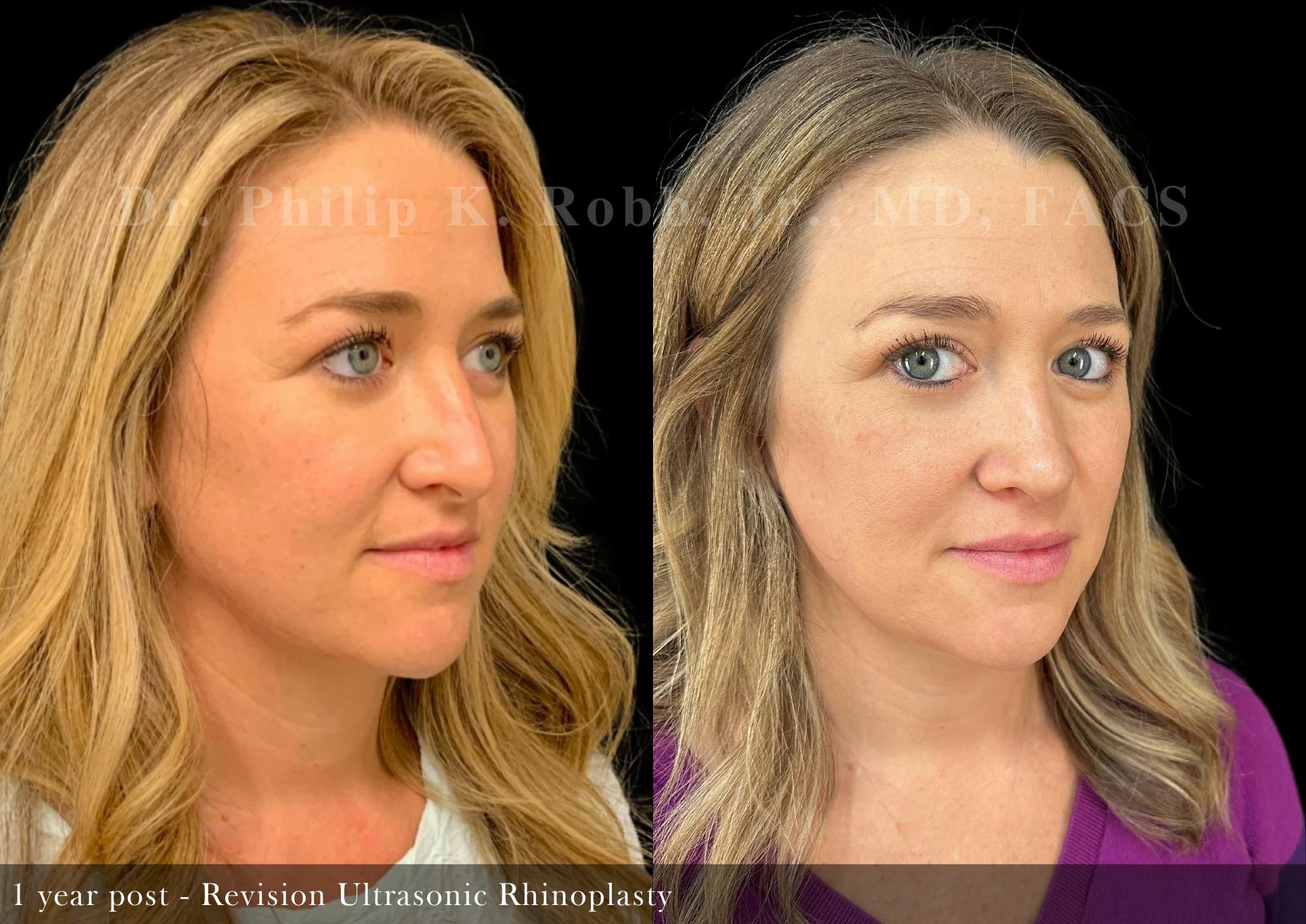 Revision Ultrasonic Rhinoplasty Before & After Gallery - Patient 965138 - Image 2