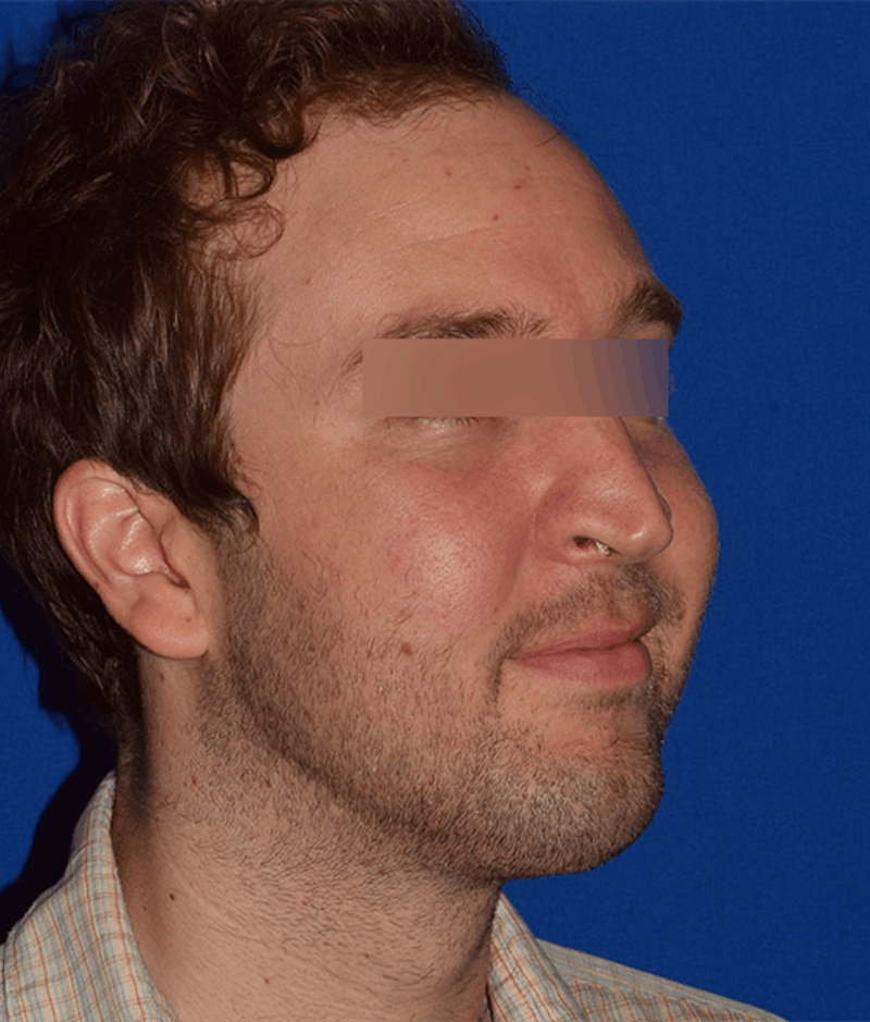 Chin Augmentation Before & After Gallery - Patient 714042 - Image 4