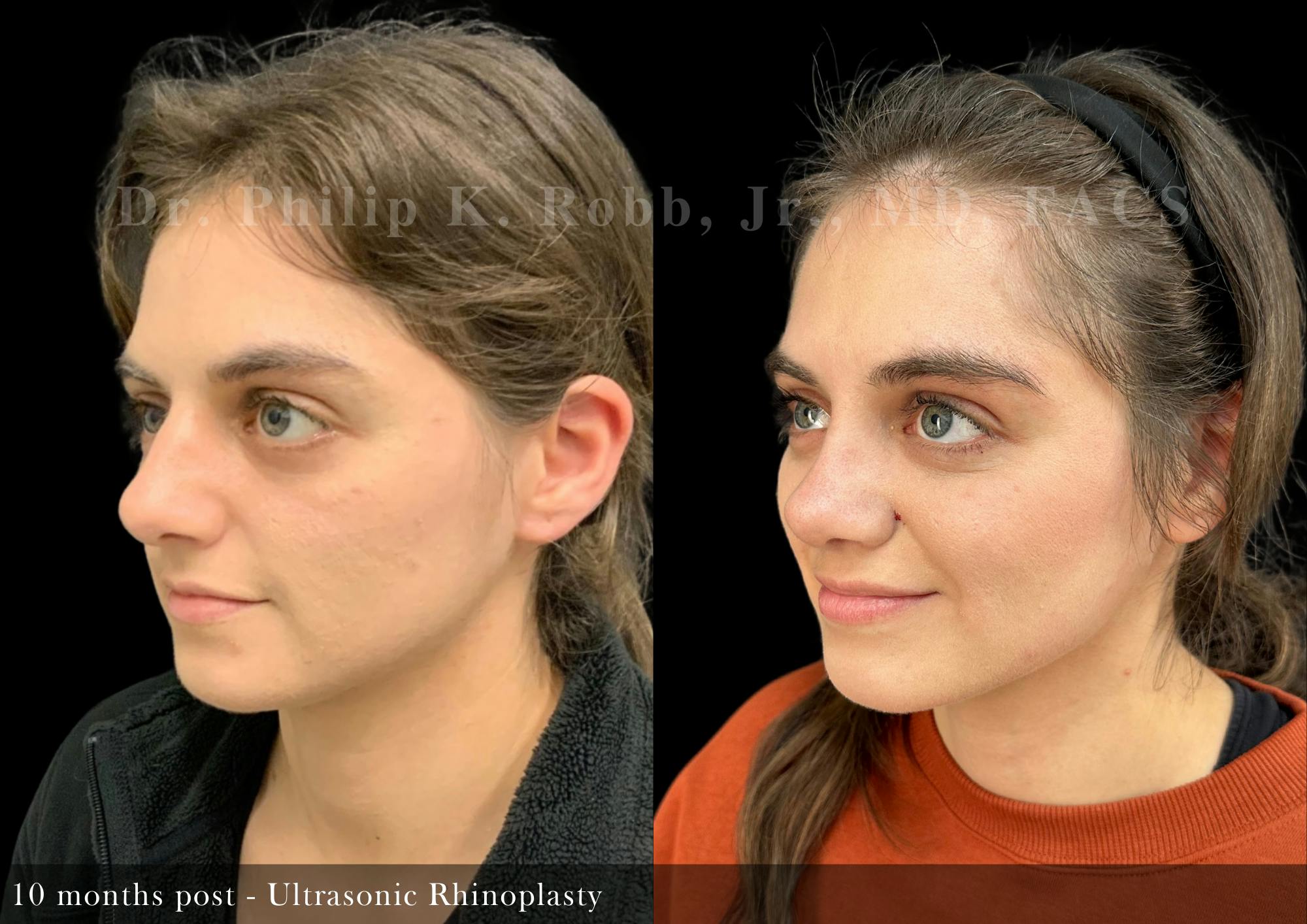 Ultrasonic Rhinoplasty Before & After Gallery - Patient 167801 - Image 5