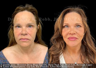 Lower Blepharoplasty Before & After Gallery - Patient 260503 - Image 1