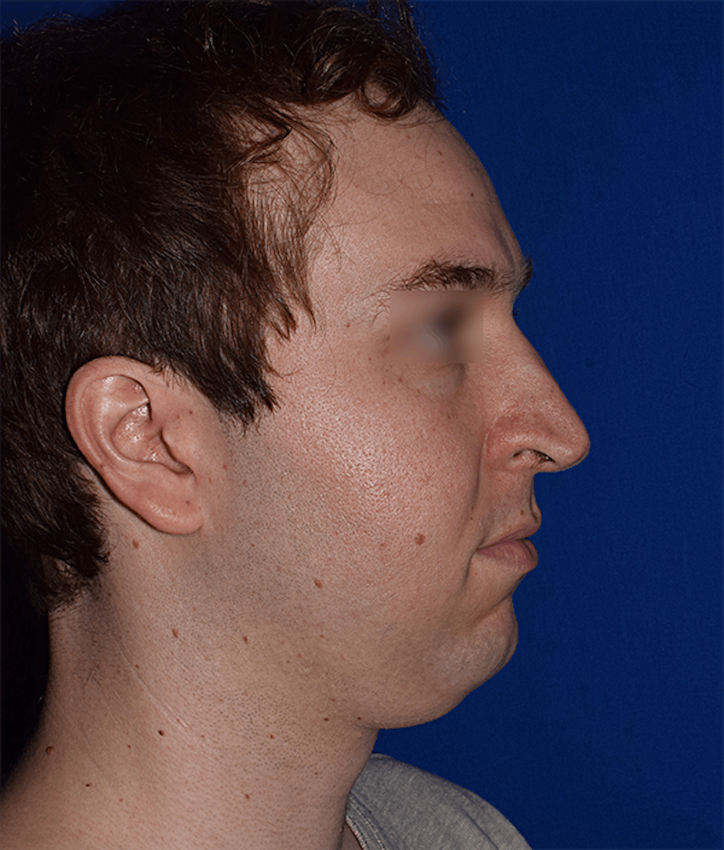 Chin Augmentation Before & After Gallery - Patient 714042 - Image 5