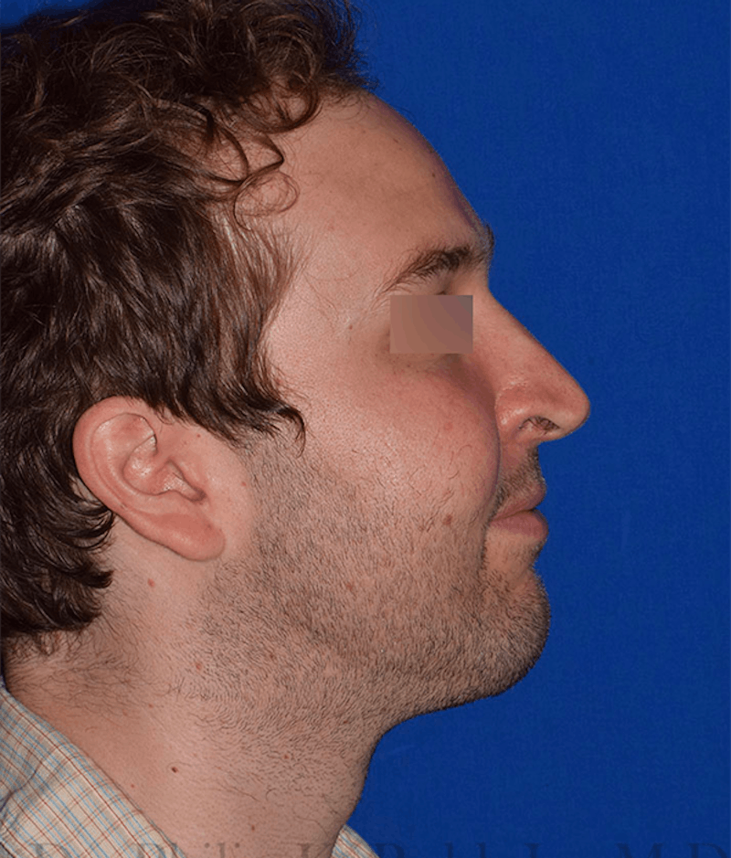 Chin Augmentation Before & After Gallery - Patient 714042 - Image 6