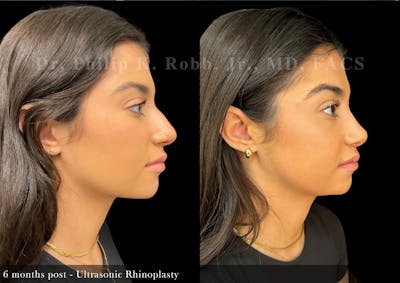 Ultrasonic Rhinoplasty Before & After Gallery - Patient 346993 - Image 1