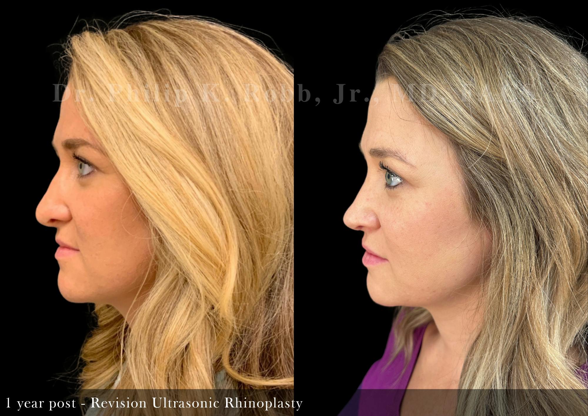 Revision Ultrasonic Rhinoplasty Before & After Gallery - Patient 965138 - Image 4