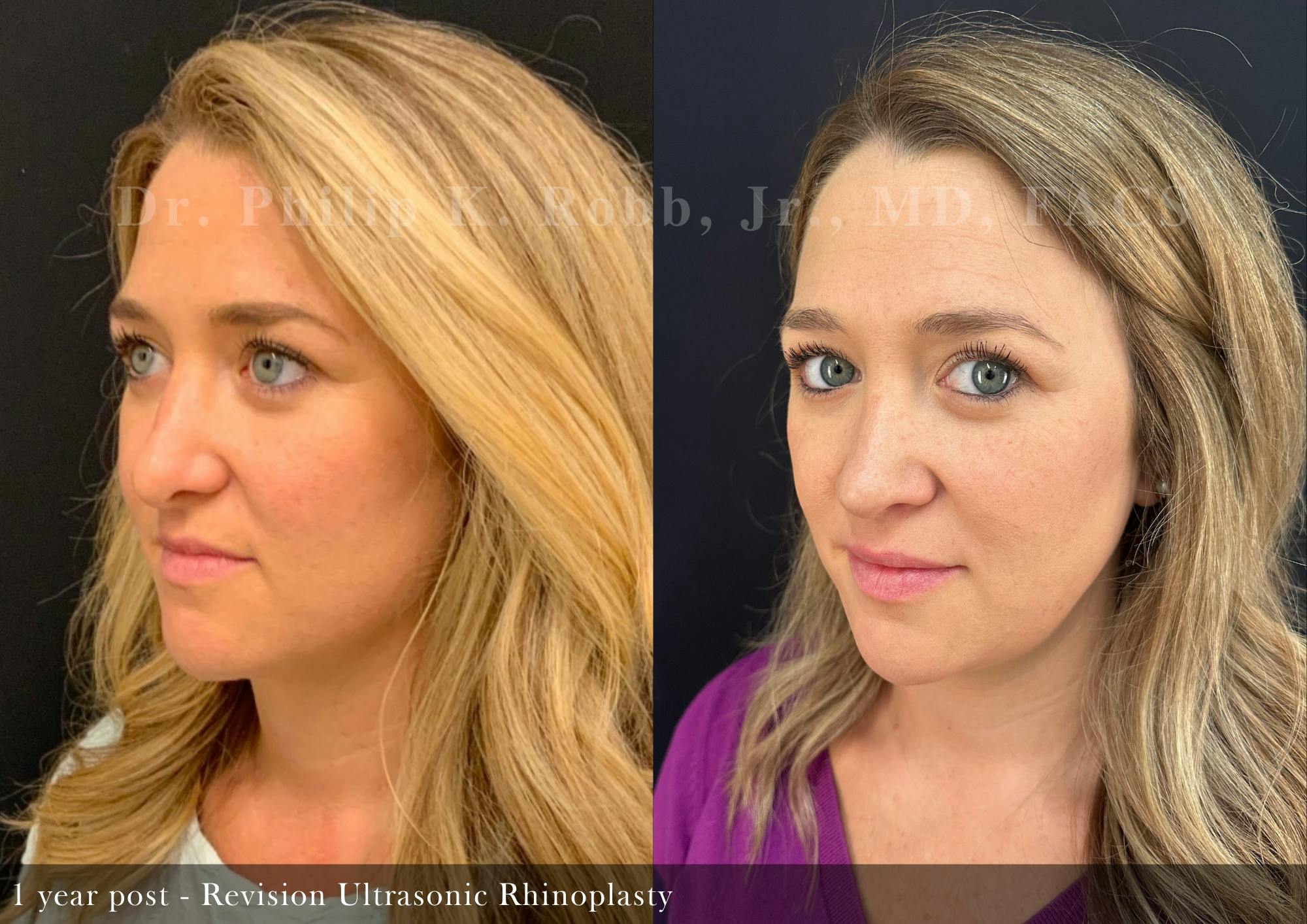 Revision Ultrasonic Rhinoplasty Before & After Gallery - Patient 965138 - Image 5