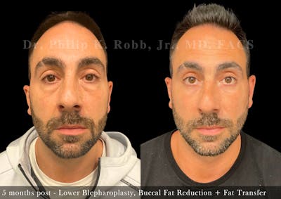 Fat Transfer Before & After Gallery - Patient 335984 - Image 1