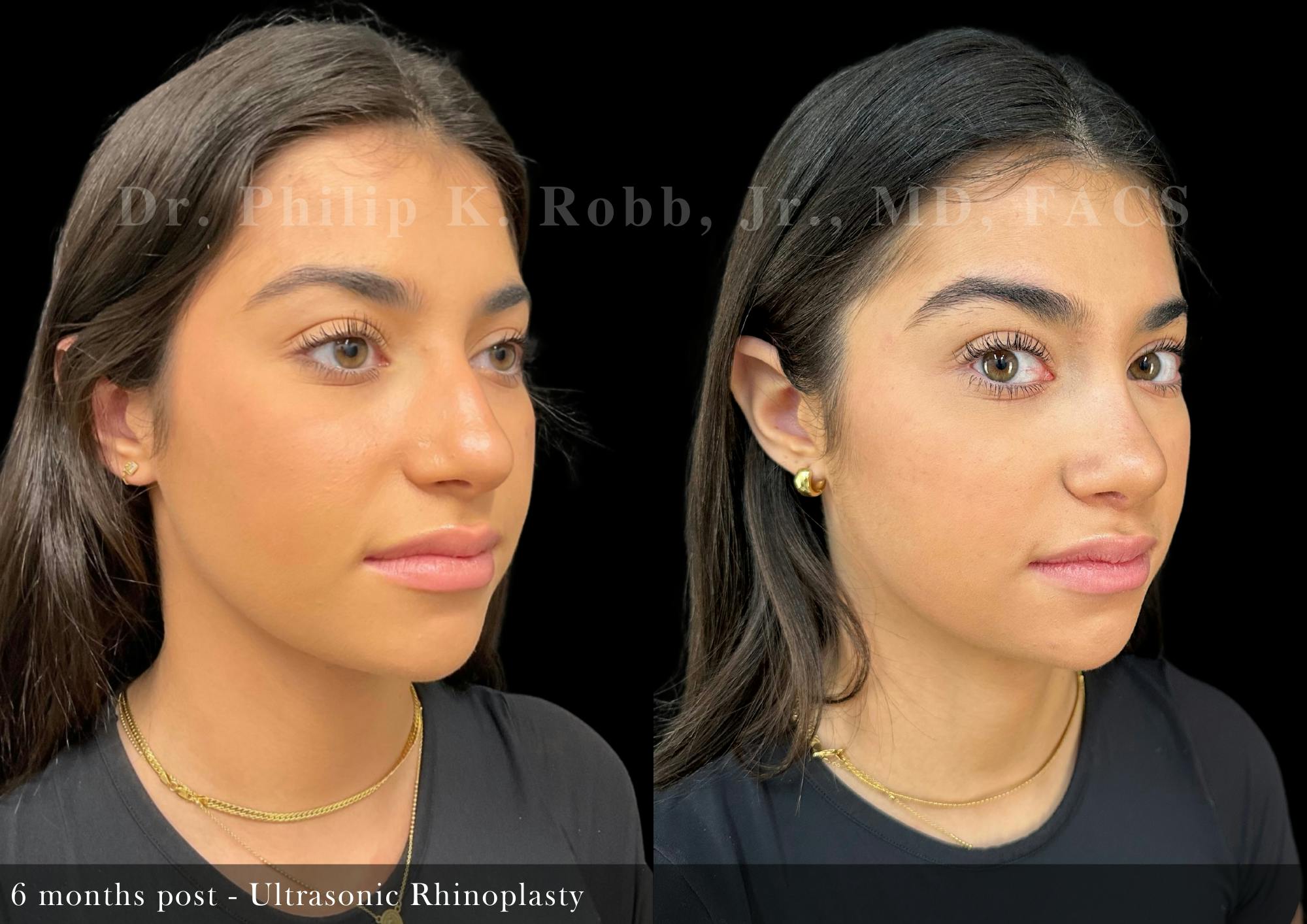 Ultrasonic Rhinoplasty Before & After Gallery - Patient 346993 - Image 2