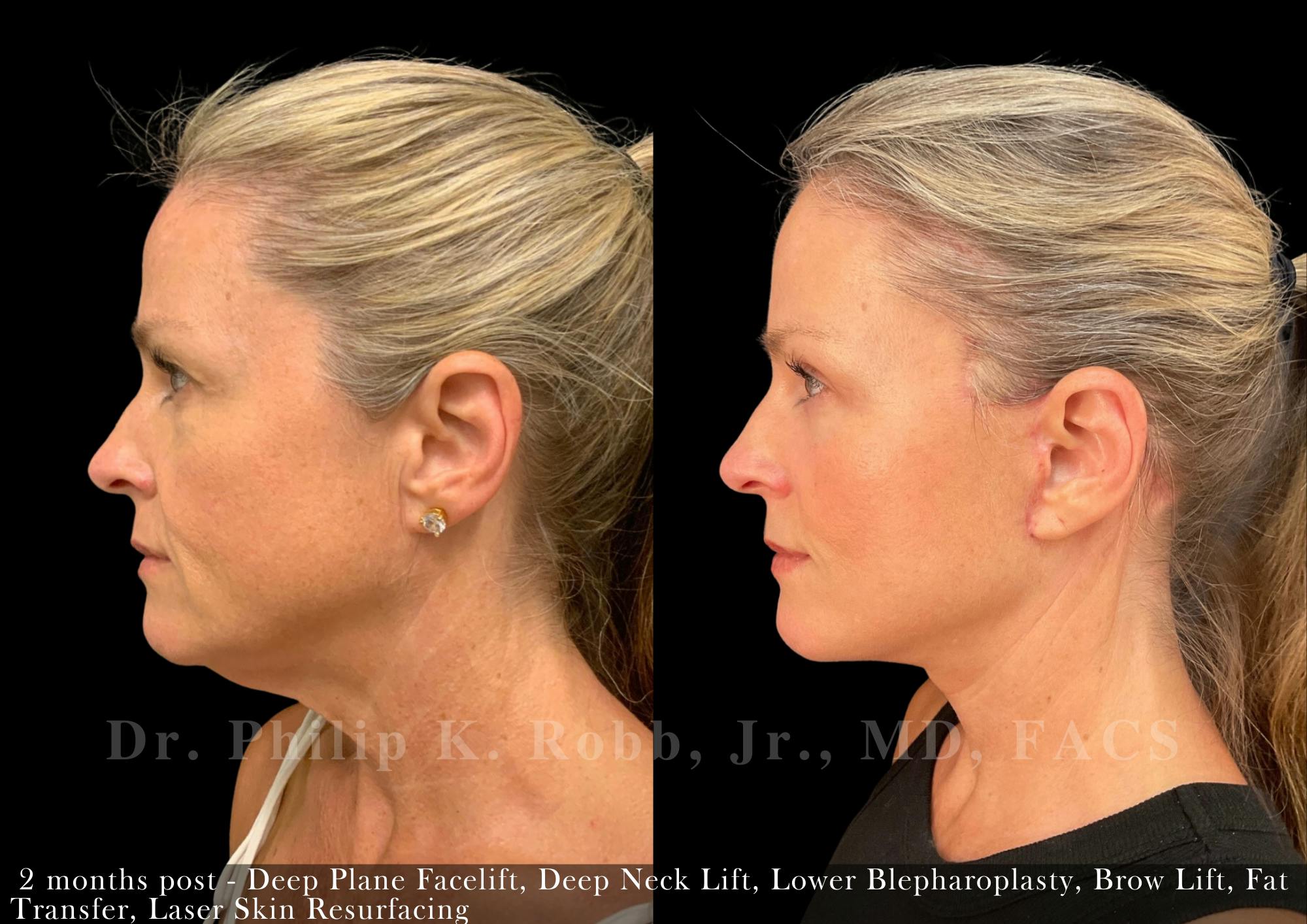 Neck Lift Before & After Gallery - Patient 230199 - Image 1