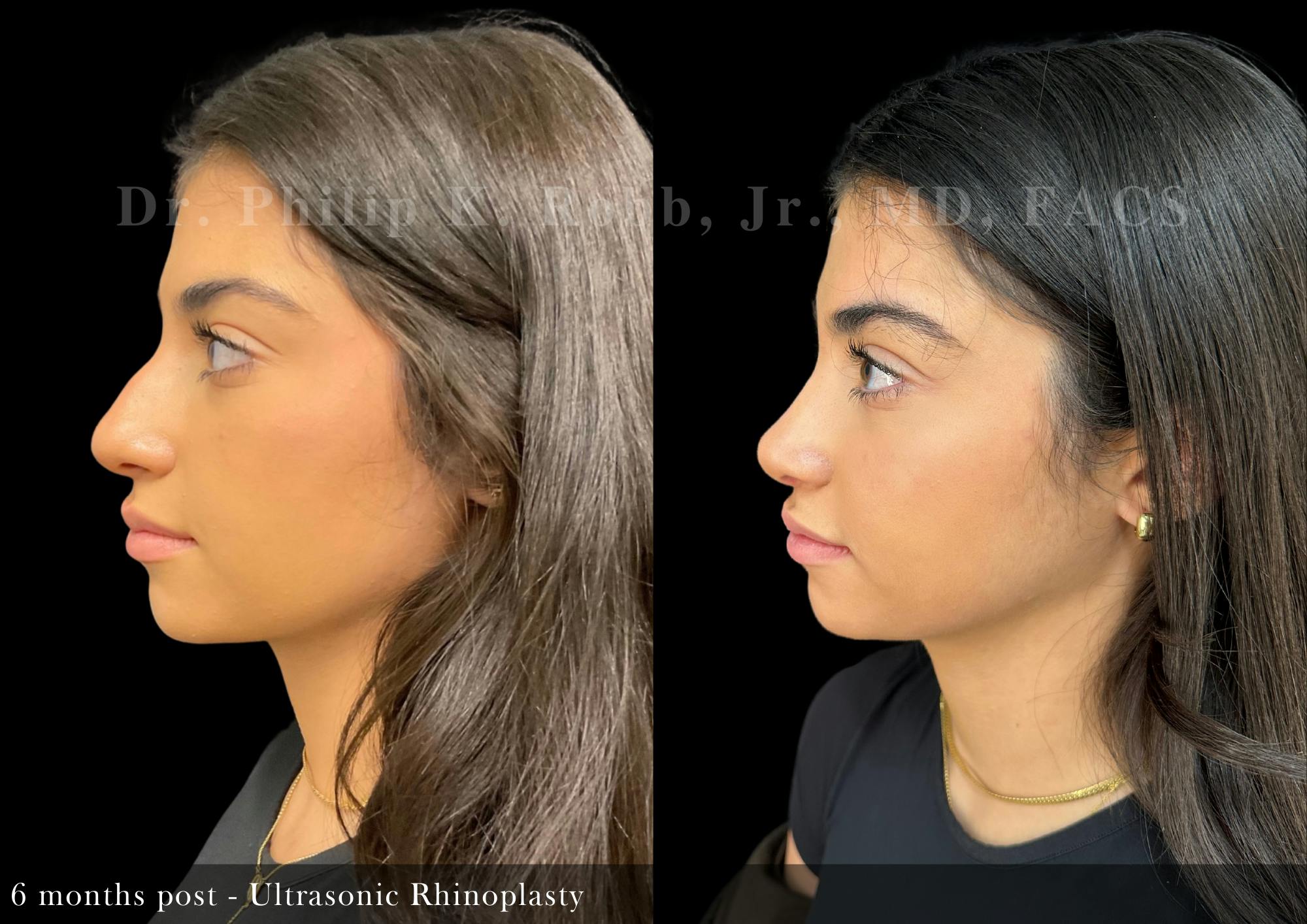 Ultrasonic Rhinoplasty Before & After Gallery - Patient 346993 - Image 4