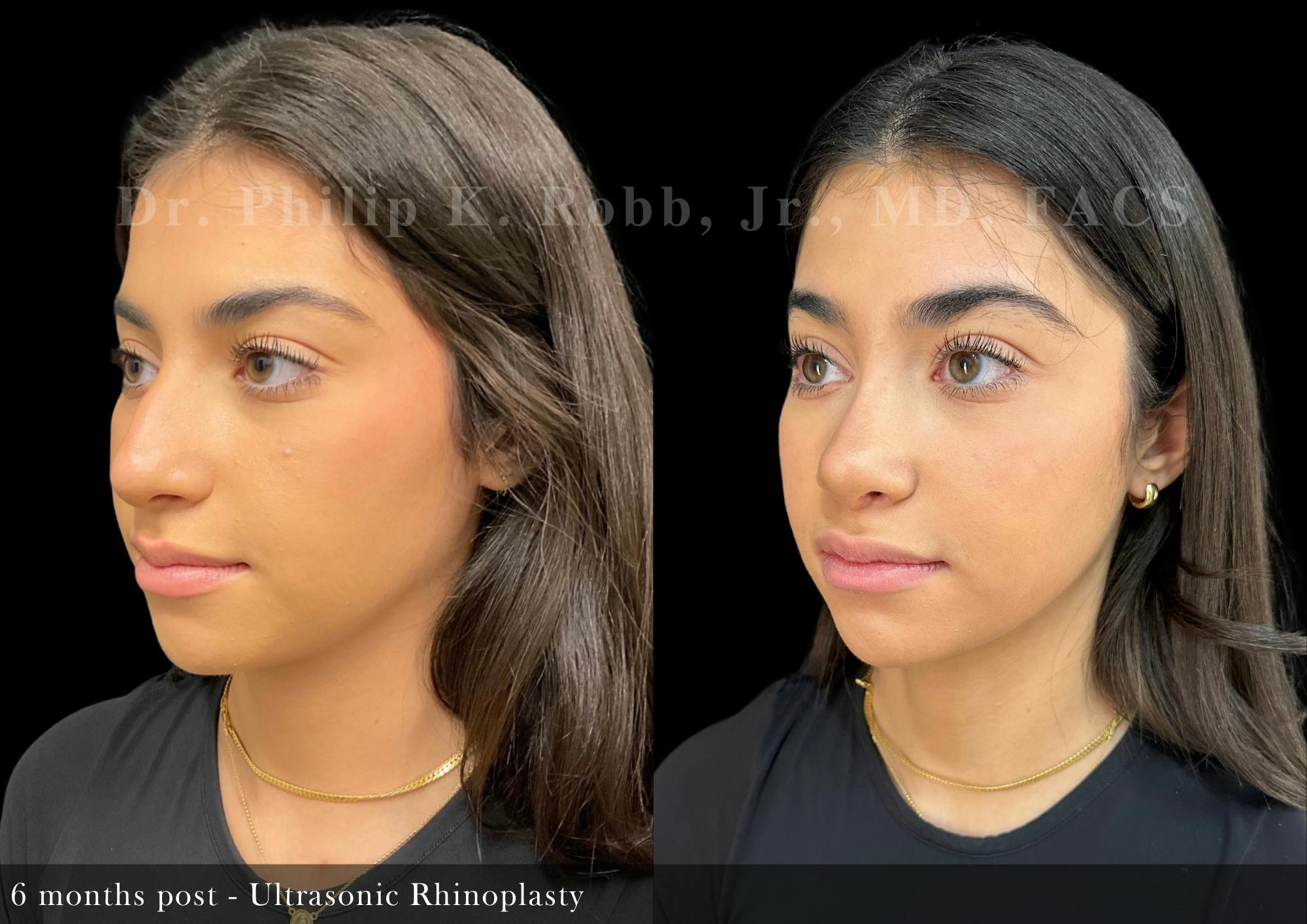 Ultrasonic Rhinoplasty Before & After Gallery - Patient 346993 - Image 5