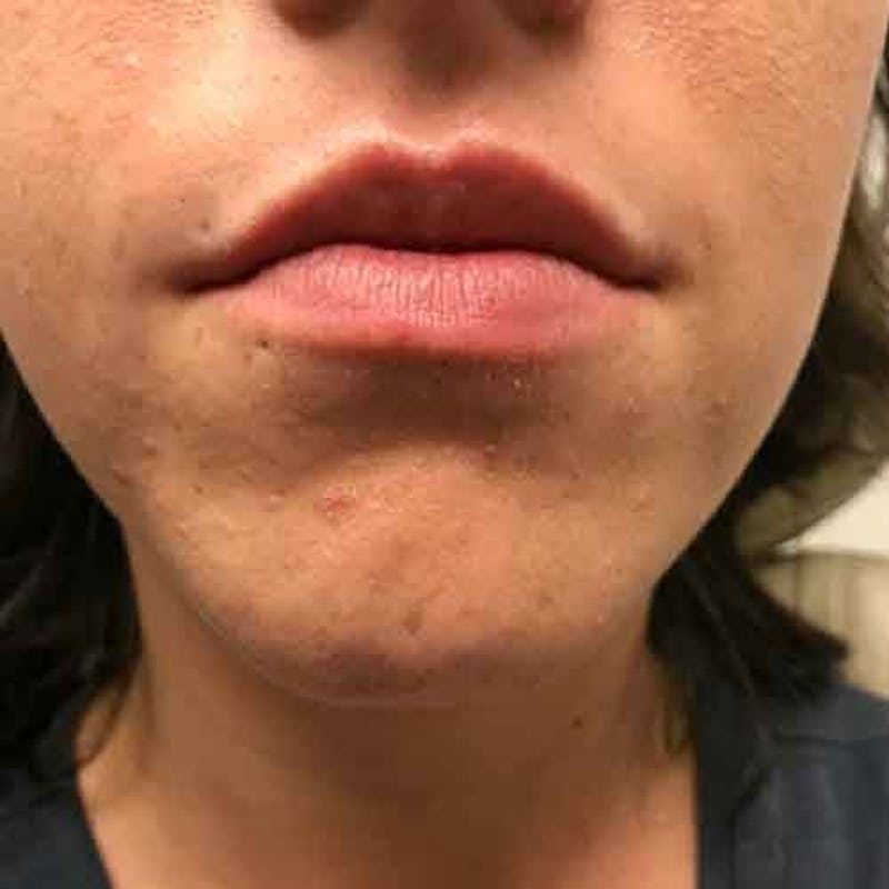 Fillers Before & After Gallery - Patient 193426 - Image 1