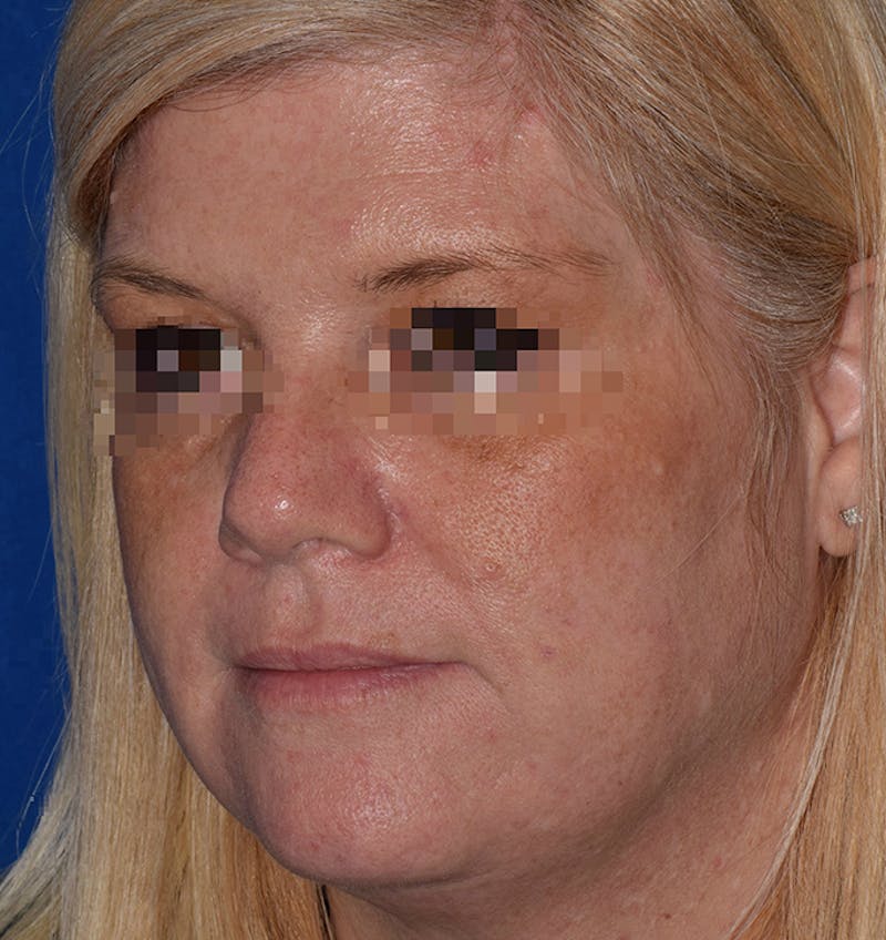 Brow Lift Before & After Gallery - Patient 202276 - Image 3