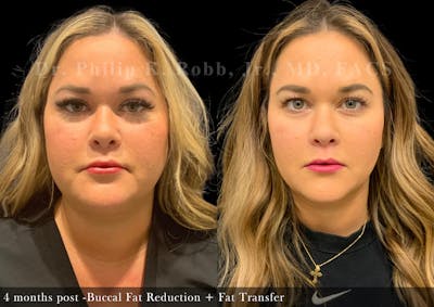 Buccal Fat Reduction Before & After Gallery - Patient 285201 - Image 1