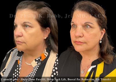 Facelift Before & After Gallery - Patient 173838 - Image 1