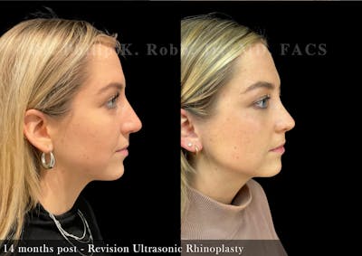 Revision Ultrasonic Rhinoplasty Before & After Gallery - Patient 163101 - Image 1