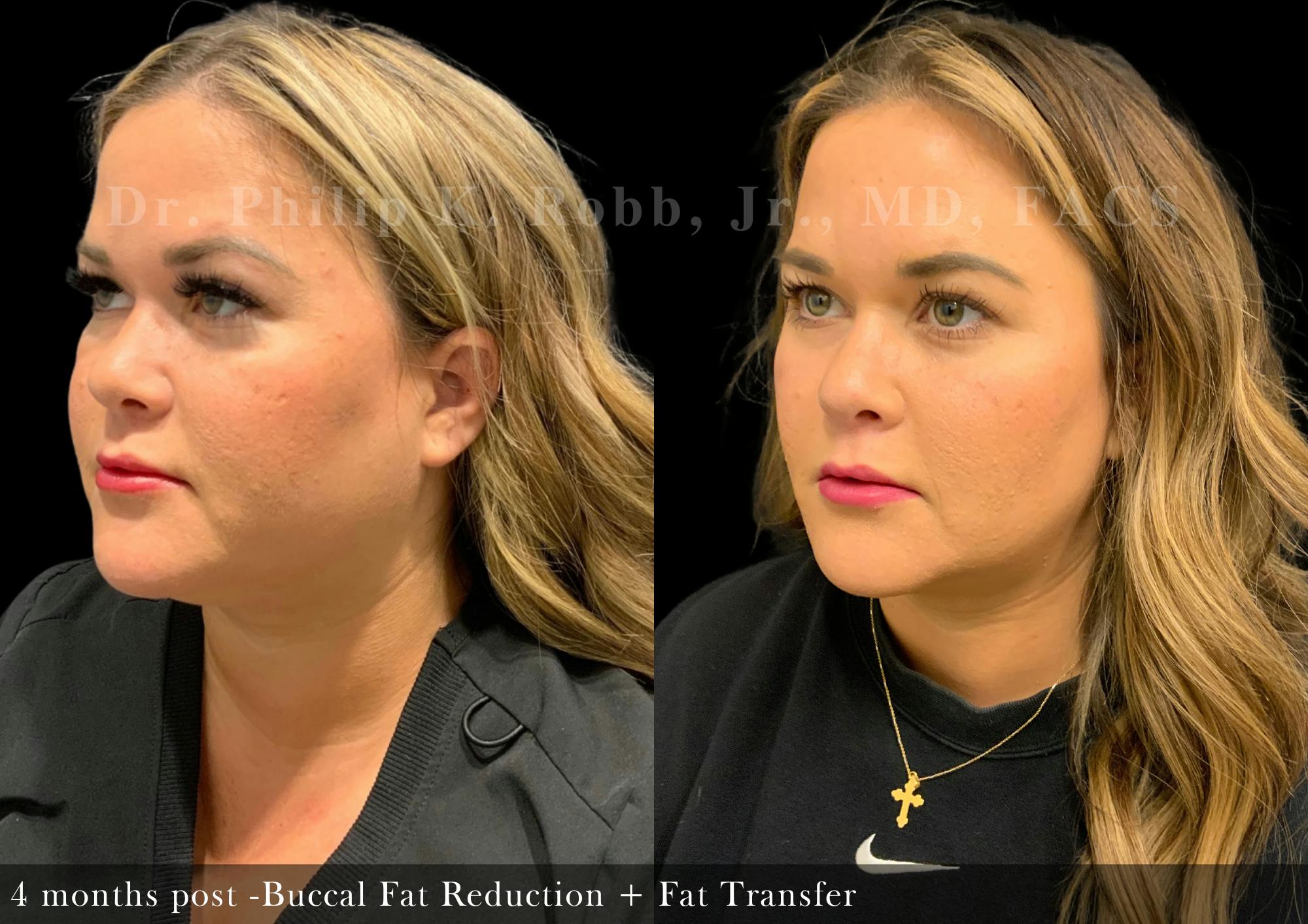 Buccal Fat Reduction Before & After Gallery - Patient 285201 - Image 2