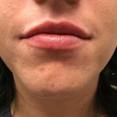 Fillers Before & After Gallery - Patient 193426 - Image 2