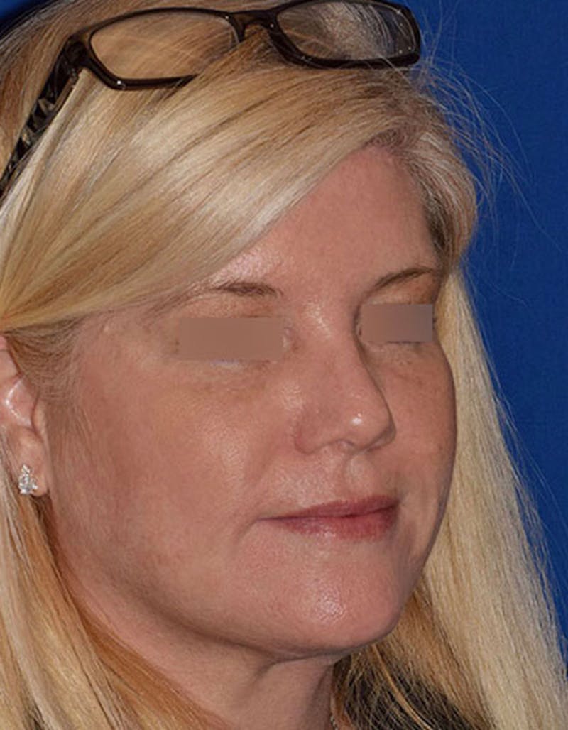 Brow Lift Before & After Gallery - Patient 202276 - Image 6