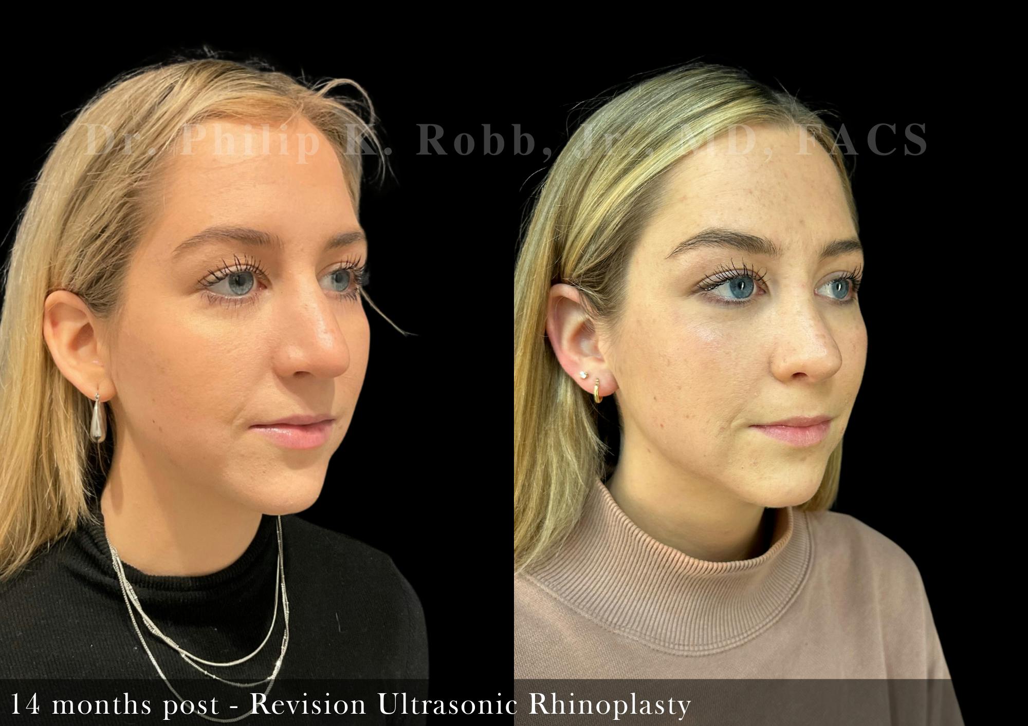 Revision Ultrasonic Rhinoplasty Before & After Gallery - Patient 163101 - Image 2