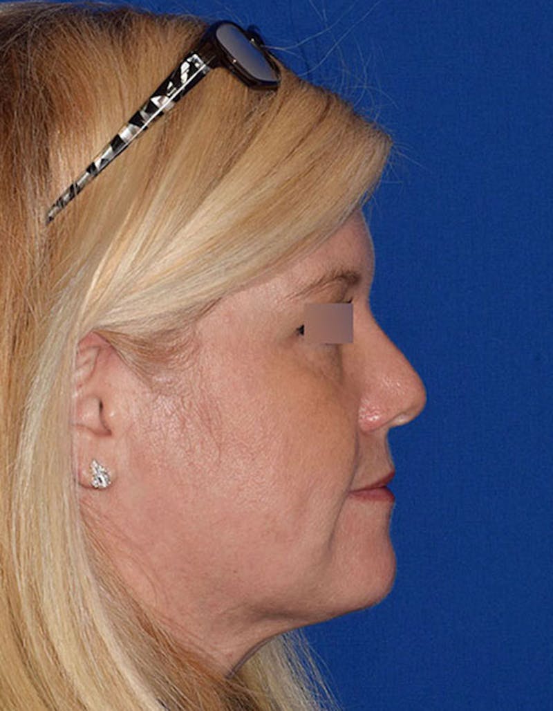 Brow Lift Before & After Gallery - Patient 202276 - Image 8