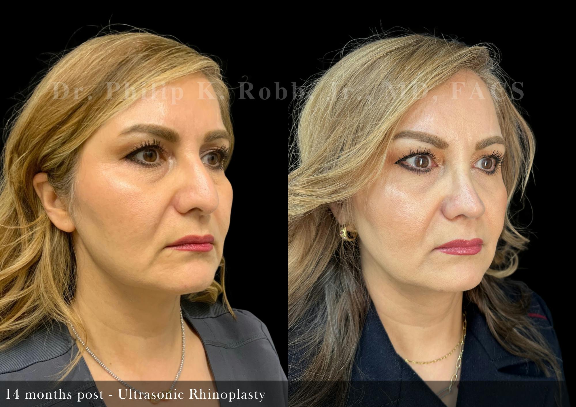 Ultrasonic Rhinoplasty Before & After Gallery - Patient 227153 - Image 2