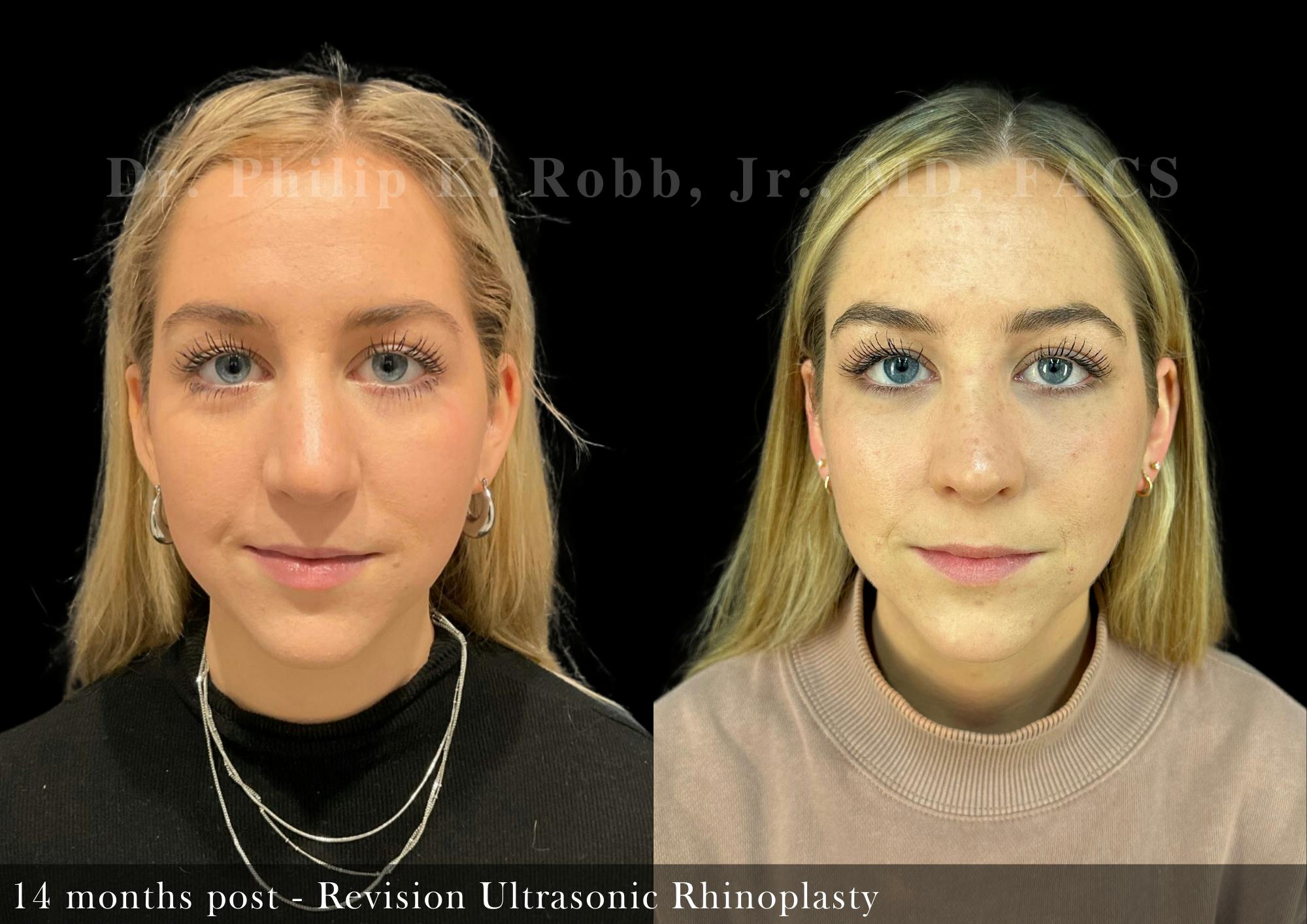 Revision Ultrasonic Rhinoplasty Before & After Gallery - Patient 163101 - Image 3