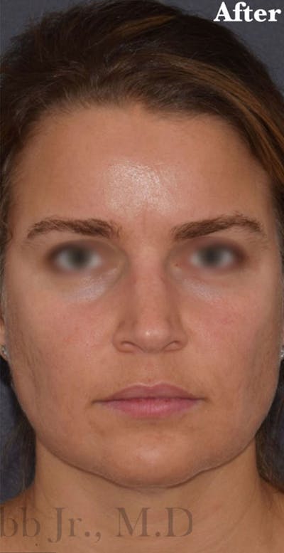 Buccal Fat Reduction Before & After Gallery - Patient 113775 - Image 2