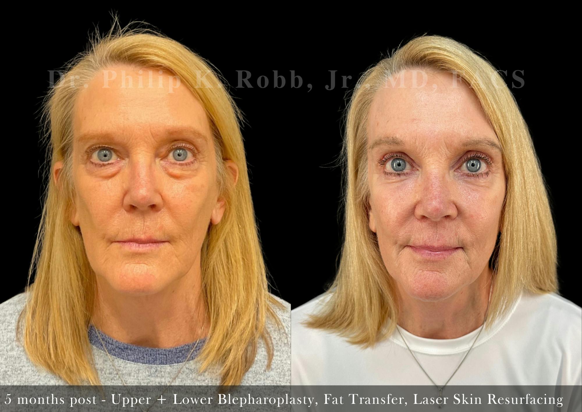 Upper Blepharoplasty Before & After Gallery - Patient 412989 - Image 1
