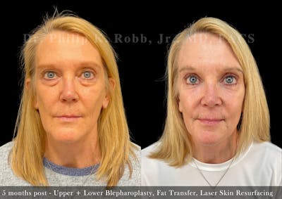 Upper Blepharoplasty Before & After Gallery - Patient 412989 - Image 1