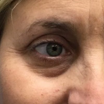 Fillers Before & After Gallery - Patient 335742 - Image 1