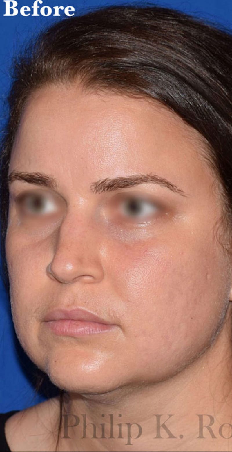 Buccal Fat Reduction Before & After Gallery - Patient 113775 - Image 3