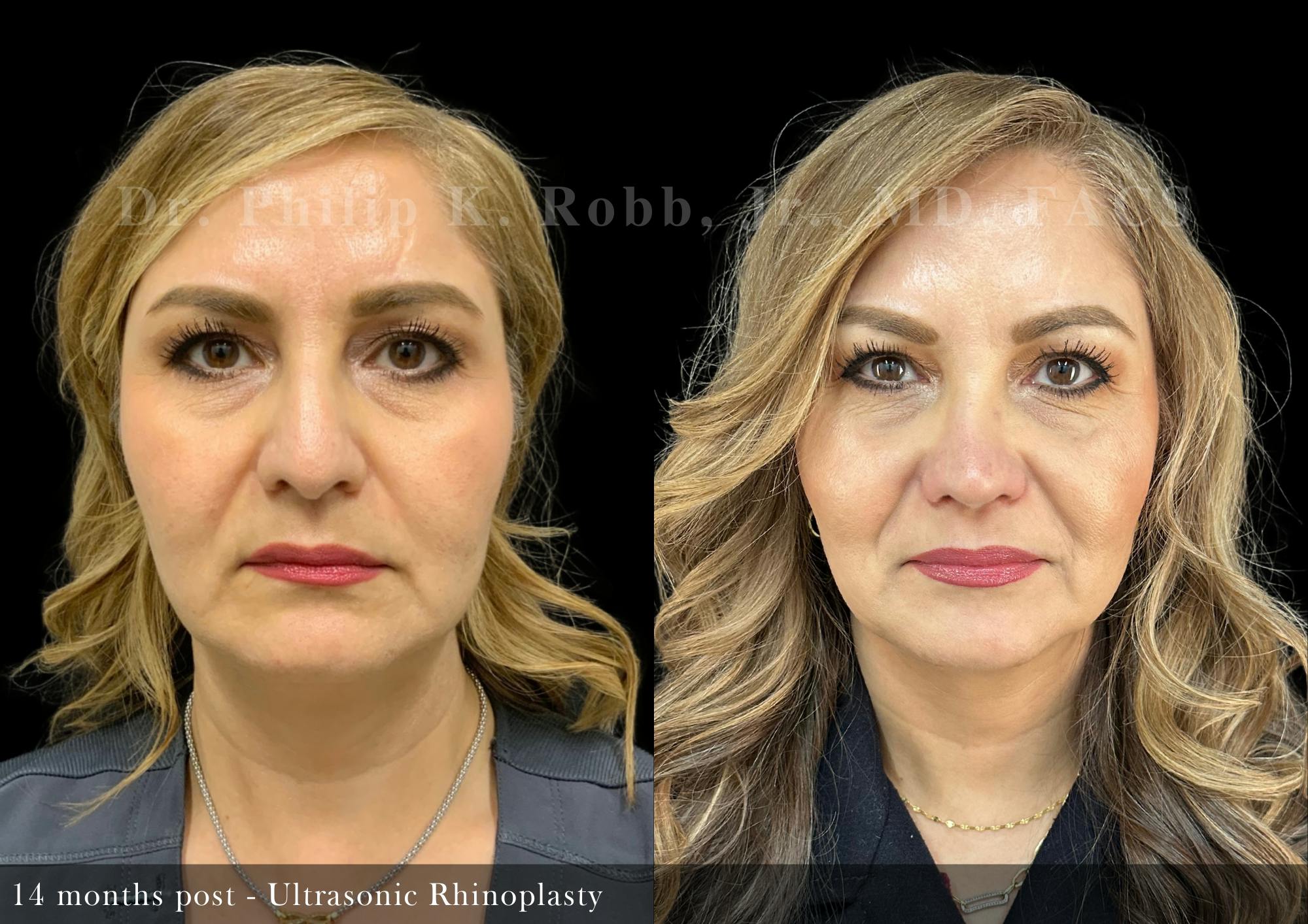 Ultrasonic Rhinoplasty Before & After Gallery - Patient 227153 - Image 3