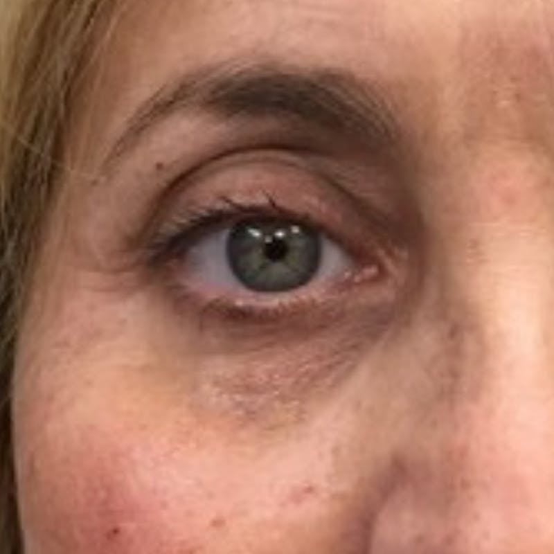 Fillers Before & After Gallery - Patient 335742 - Image 2