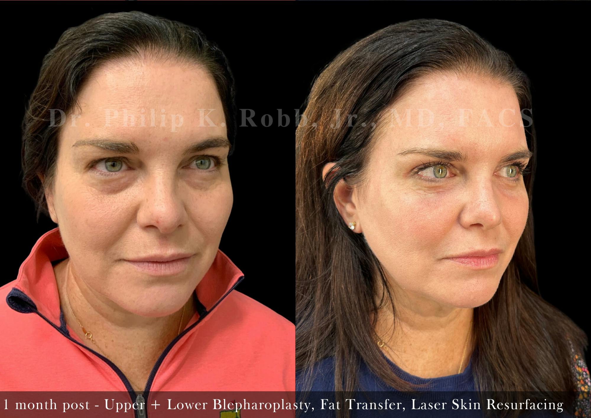 Fat Transfer Before & After Gallery - Patient 157398 - Image 3