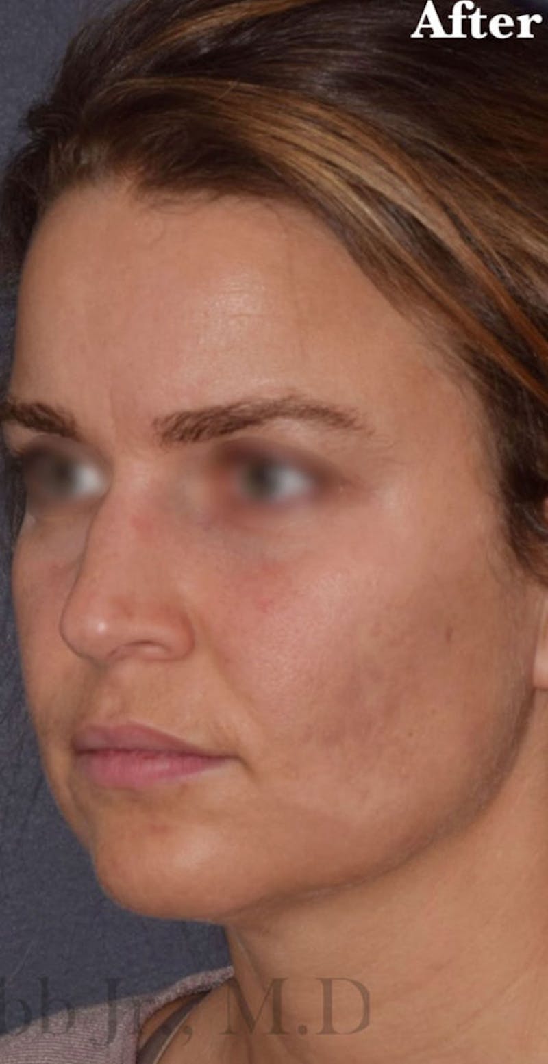 Buccal Fat Reduction Before & After Gallery - Patient 113775 - Image 4
