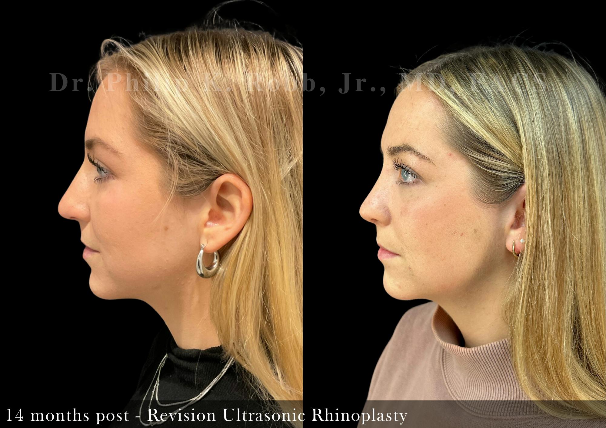 Revision Ultrasonic Rhinoplasty Before & After Gallery - Patient 163101 - Image 4