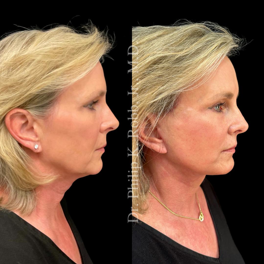 Brow Lift Before & After Gallery - Patient 267630 - Image 3